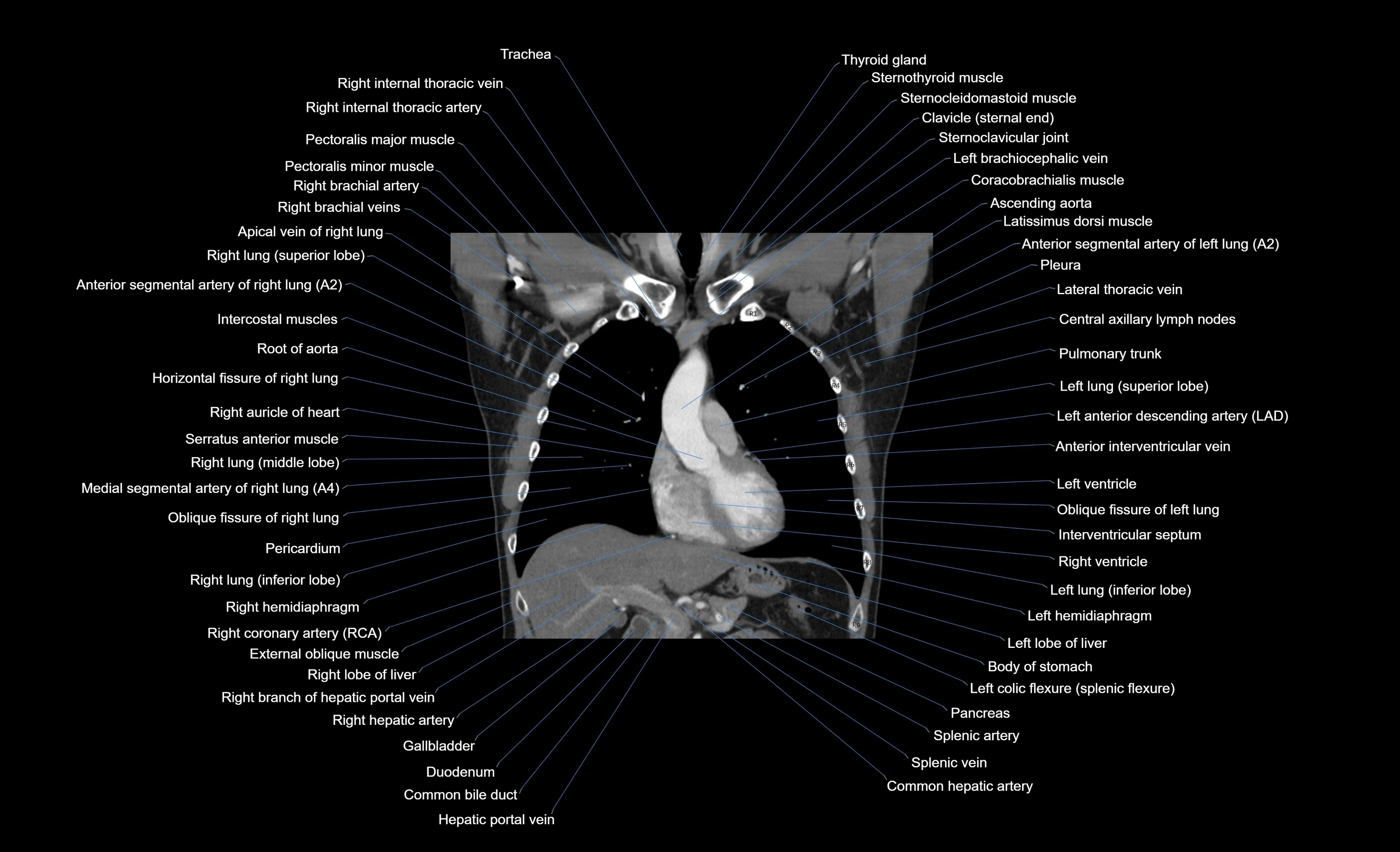 CT chest (thorax) soft tissue window labelled coronal cross sectional anatomy radiology image-00075.webp